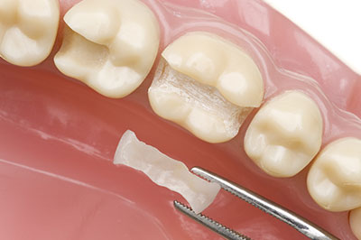 Next Generation Dental | Implant Dentistry, Dental Bridges and Extractions