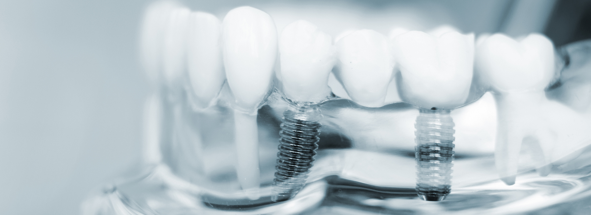 Next Generation Dental | Dental Bridges, Preventative Program and Dentures