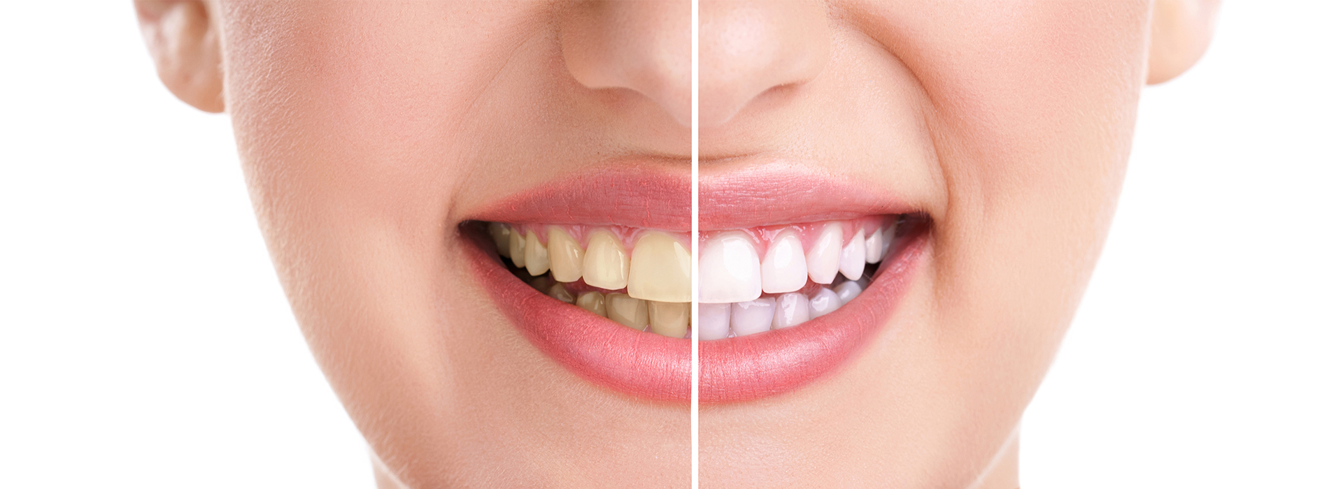 Next Generation Dental | Oral Exams, Dental Fillings and Inlays amp Onlays